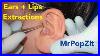 Acne Extractions Large Blackheads And Whiteheads In The Ears And On The Lips Mrpopzit