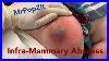 Infra Mammary Abscess Large Pocket Of Fluid Drained With Incision U0026 Drainage